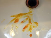 Diarrhea with blood in infants