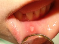 Aphthous stomatitis in a child