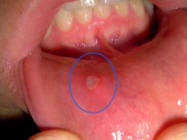 Aphthous stomatitis in a child