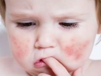 Red cheeks during diathesis in a child