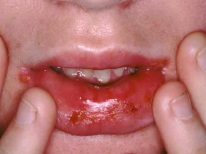 Herpes stomatitis in a child