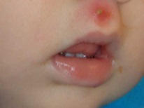 Herpes stomatitis in a child’s skin