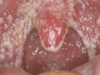 Thrush in the mouth in newborns