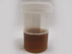 Brown urine in a child