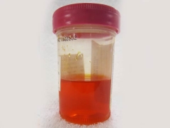 Red urine in a child