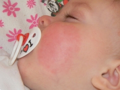 Treatment of diathesis on the cheeks in a child