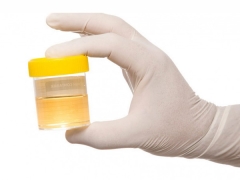 Turbid urine in a child