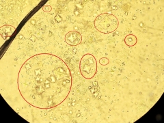 Oxalates in the urine of a child