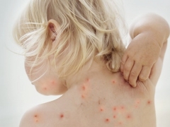 What and how can you relieve the itch of chickenpox?