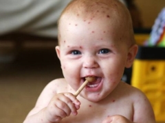 How chickenpox begins: the first signs