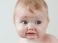 Chicken pox in babies