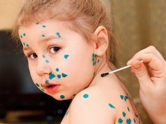 Symptoms, signs and treatment of varicella in children