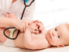 Possible complications after chickenpox in children