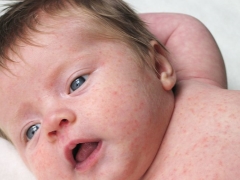 Rubella in infants and newborns