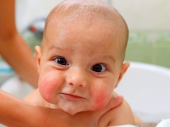 Atopic dermatitis in infants