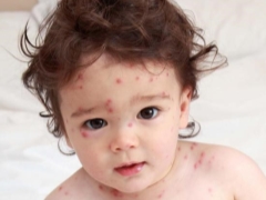 Symptoms, treatment and prevention of measles in children