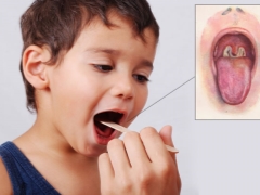 Symptoms, treatment and prevention of diphtheria in children