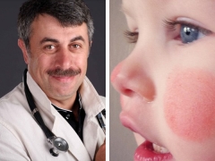 Dr. Komarovsky about red cheeks in a child