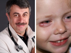 Dr. Komarovsky on how to treat barley on the eyes of a child