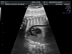 Biochemical screening in the first trimester