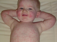 What if there is a rash all over the child’s body, and there is no temperature?