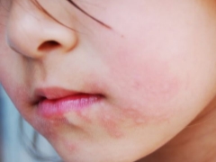 What if there is irritation or a rash around the child’s mouth?