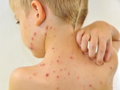 What to do if a child has a rash on a background of high fever?