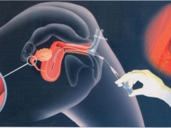 What is intrauterine insemination and how is the procedure performed?