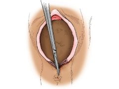 What is perineotomy and when is it used in childbirth?