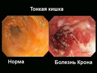 Crohn's disease