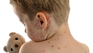 Chickenpox incubation period