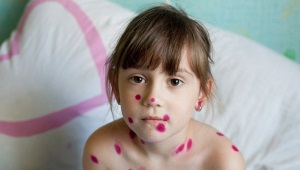 Is it possible to walk a child with chickenpox