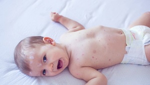 Colorless means of chickenpox