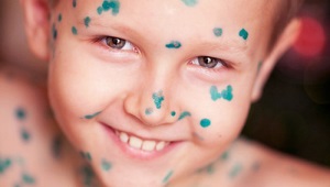 How and what to treat chickenpox at home?