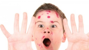 How to find out if a person has had chickenpox: everything about the analysis of antibodies to chickenpox