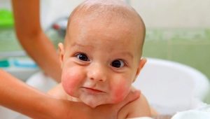 Atopic dermatitis in infants