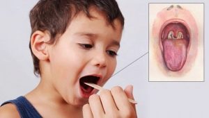 Symptoms, treatment and prevention of diphtheria in children