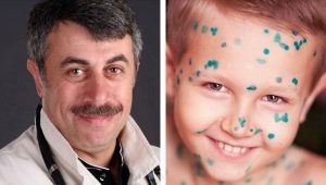 Dr. Komarovsky: what is chickenpox and how to treat it