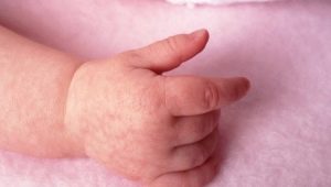 Marble skin in infants and newborns: causes, symptoms, and treatment