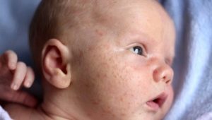 What does an allergic rash look like in children?