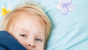 What does an enteroviral infection rash look like in children?