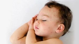 Why did the child have a rash and what to do?