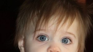 Anisocoria - different pupils in size in a child