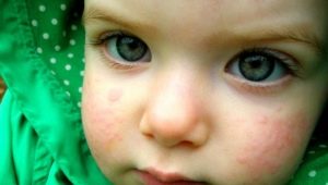 What if there is a rash on the face of a child?