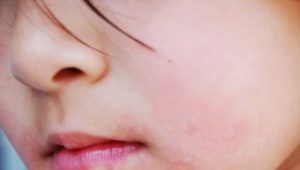 What if there is irritation or a rash around the child’s mouth?