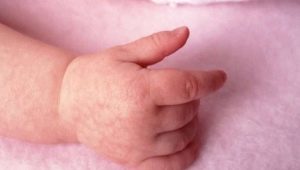 Why can a rash appear in the hands of a child and what to do?