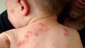 Rash on baby's back