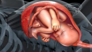 Types of umbilical cord attachment to the placenta: norms and risk of deviations