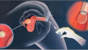 What is intrauterine insemination and how is the procedure performed?