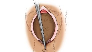 What is perineotomy and when is it used in childbirth?